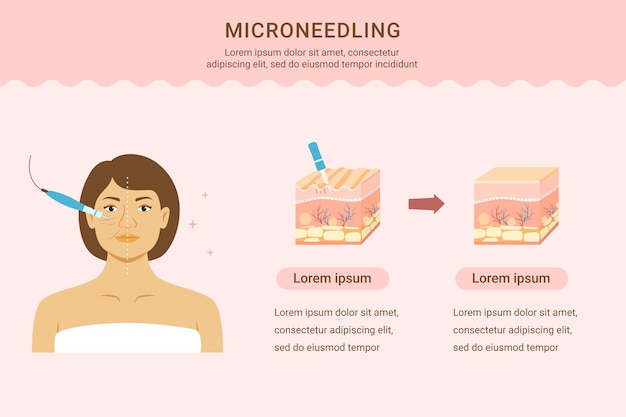 Hand drawn flat design micro needling infographic