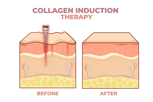 Free Vector hand drawn flat design micro needling infographic