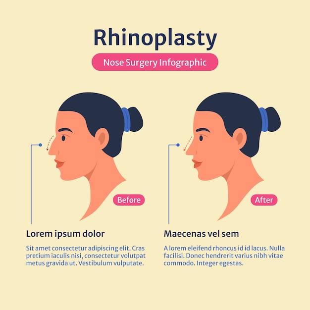 Hand drawn flat design rhinoplasty infographic