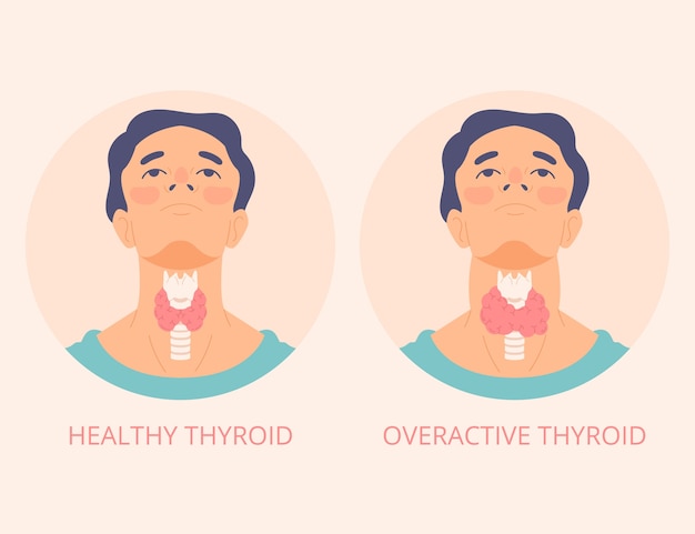 Hand drawn flat design thyroid illustration