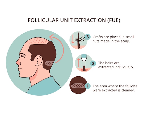 Hand drawn hair transplant infographic