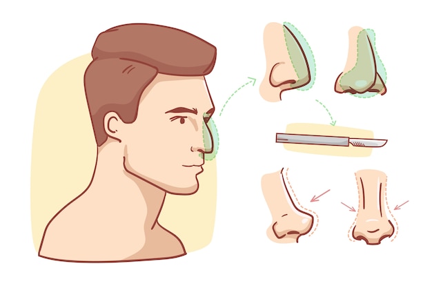 Hand drawn rhinoplasty infographic