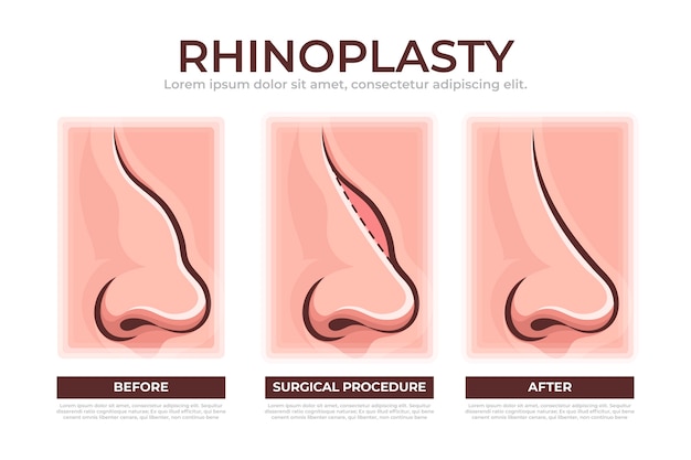 Hand drawn rhinoplasty infographic