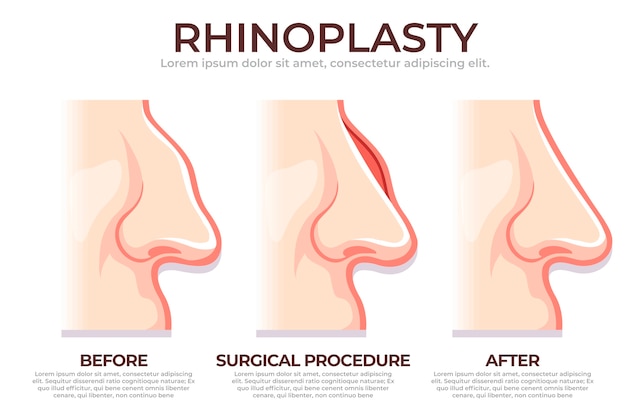 Hand drawn rhinoplasty infographic