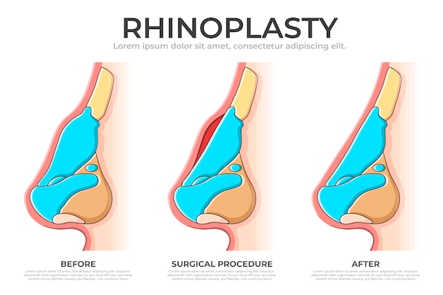 Hand drawn rhinoplasty infographic