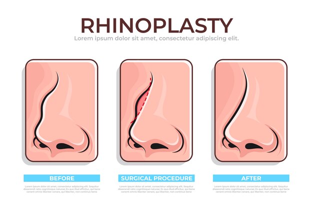 Hand drawn rhinoplasty infographic