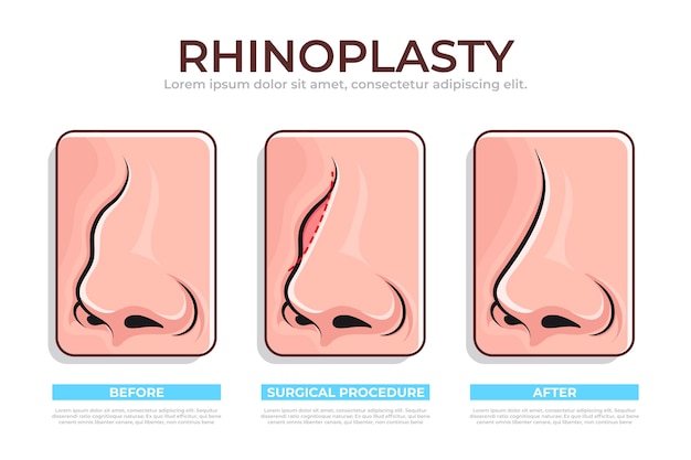 Hand drawn rhinoplasty infographic