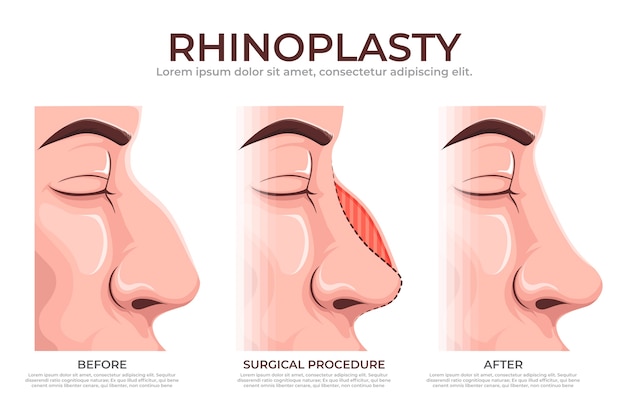 Hand drawn rhinoplasty infographic