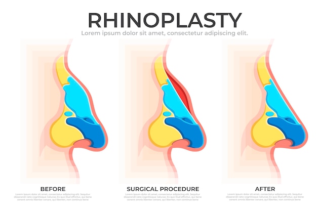 Free Vector hand drawn rhinoplasty infographic