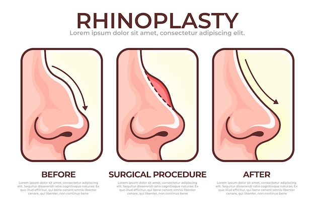 Hand drawn rhinoplasty infographic