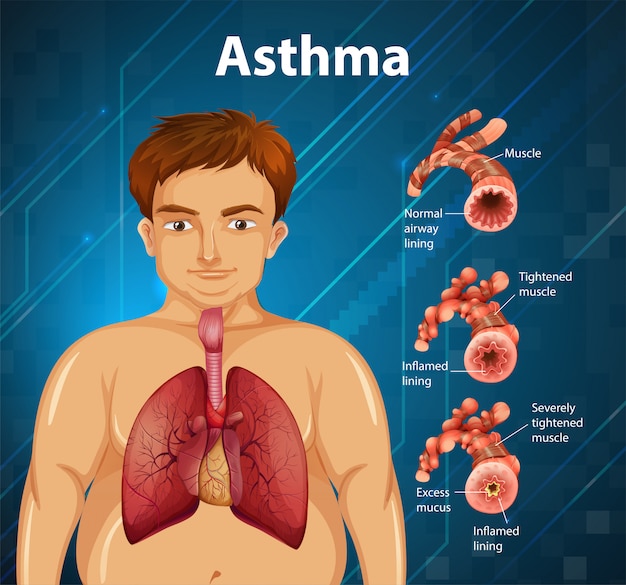 Human anatomy Asthma diagram