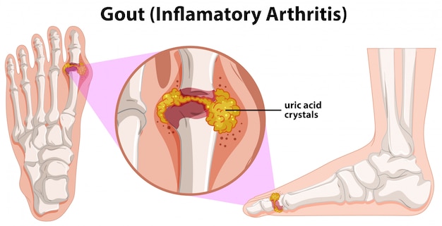 Free Vector a human anatomy of gout