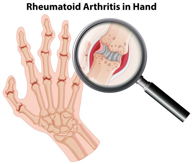 Human anatomy rheumatoid arthritis in hand