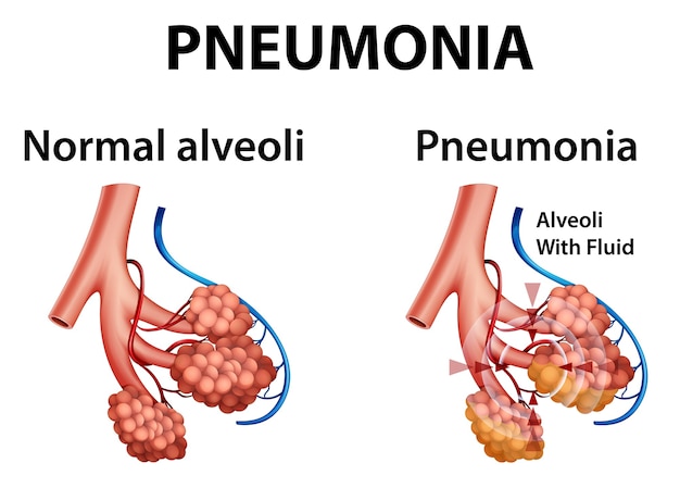 Human anatomy showing pneumonia