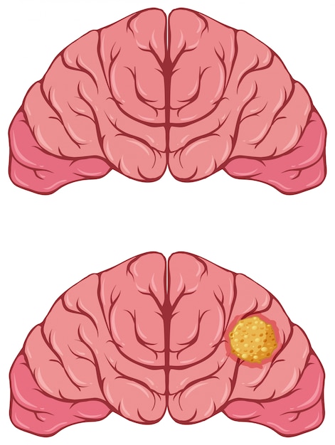 Free vector human brain with cancer