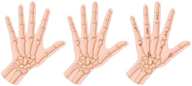 Human hands with bone fracture illustration