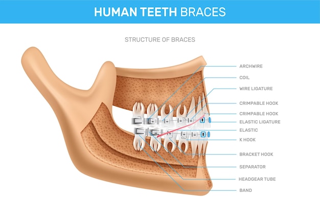 Human Teeth Braces Realistic Infographics