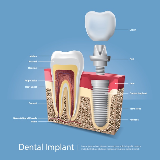 Human teeth and Dental implant Vector Illustration