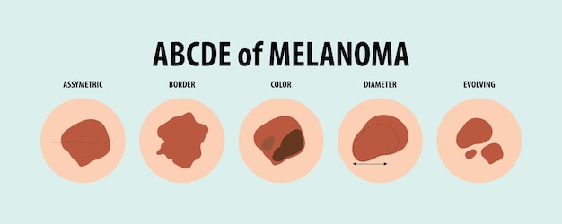 Free Vector illustrated guide to five types of skin cancer