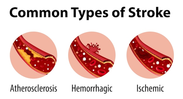 Free Vector infographic of common types of stroke