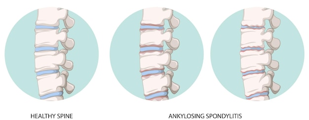 Infographic of healthy spine and ankylosing spondylitis