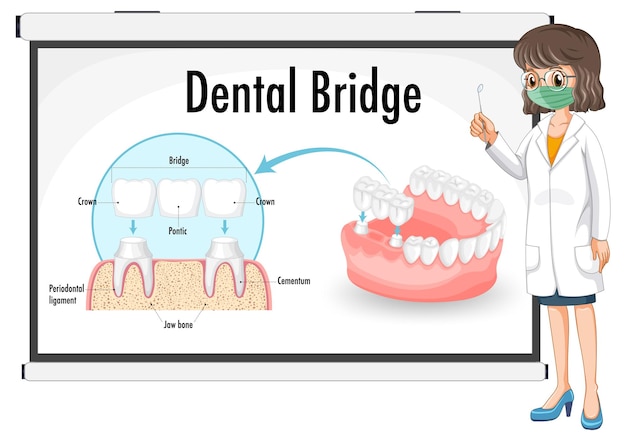 Free vector infographic of human in dental bridge on white background