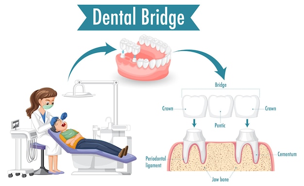 Free vector infographic of human in dental bridge on white background