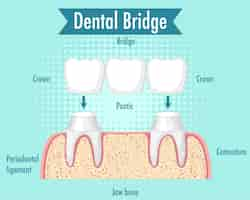 Free vector infographic of human in dental bridge