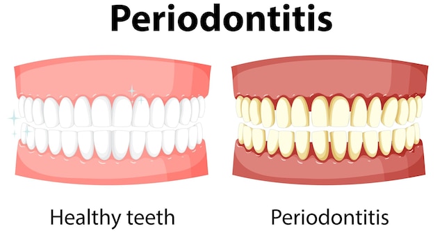 Free Vector infographic of human in periodontitis