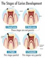 Free vector infographic of human in the stages of caries development