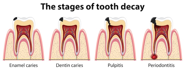 Free Vector infographic of human in the stages of tooth decay