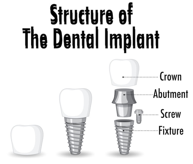 Infographic of human in structure of the dental implant