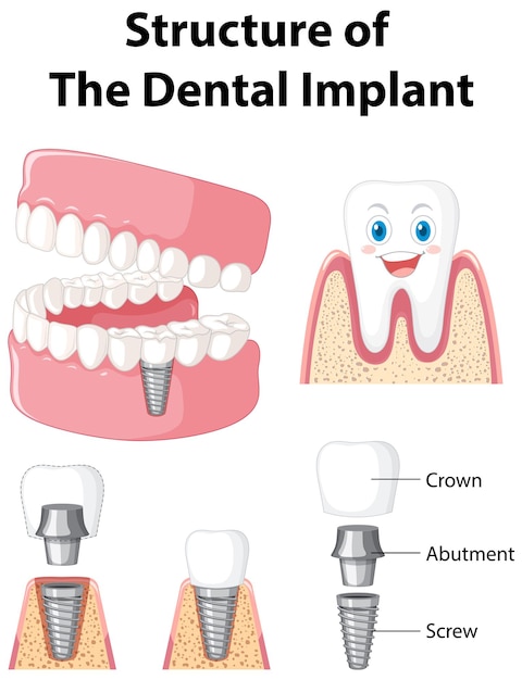 Free Vector infographic of human in structure of the dental implant