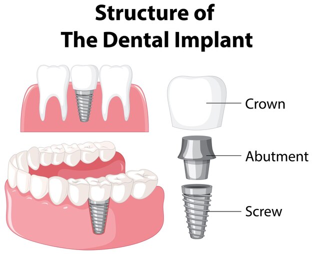 Infographic of human in structure of the dental implant