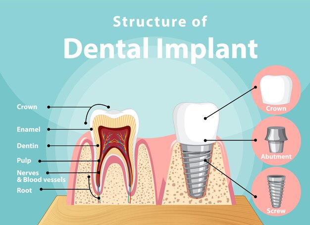 Infographic of human in structure of the dental implant