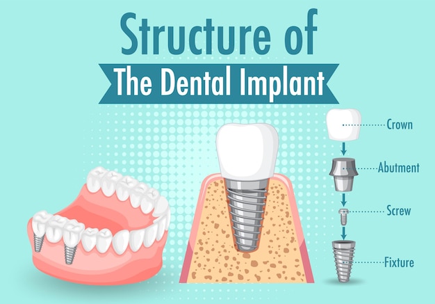 Free Vector infographic of human in structure of the dental implant