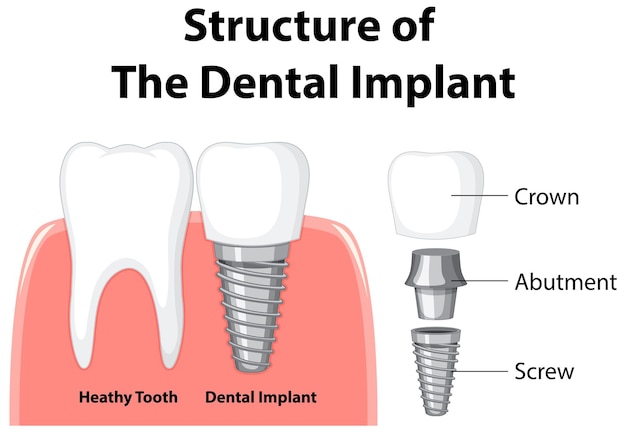 Infographic of human in structure of the dental implant