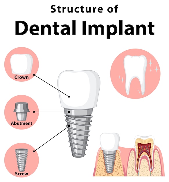 Infographic of human in structure of the dental implant