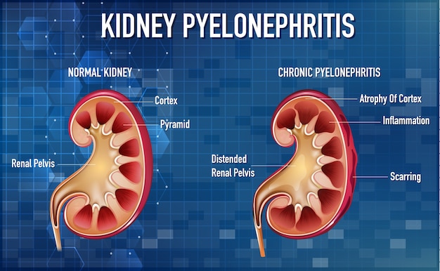 Informative illustration of Pyelonephritis