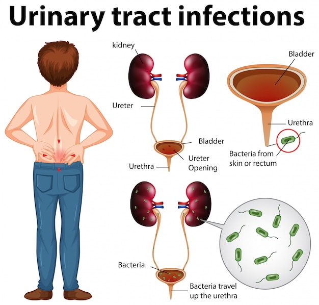 Free vector informative illustration of urinary tract infections