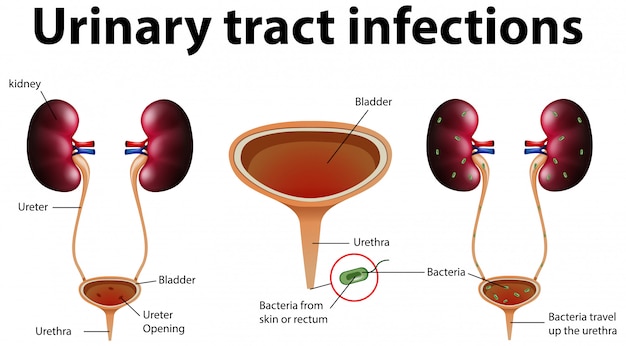 Free vector informative illustration of urinary tract infections