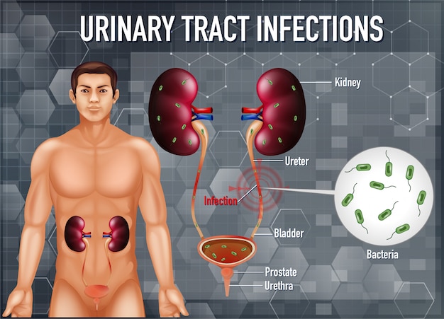 Free Vector informative illustration of urinary tract infections