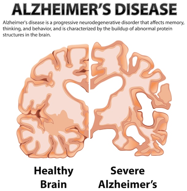 Free Vector informative poster of alzheimers disease