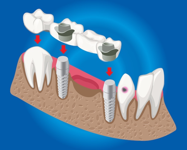 Free Vector isometric prosthetic dentistry concept with dental bridge used for missing teeth covering isolated