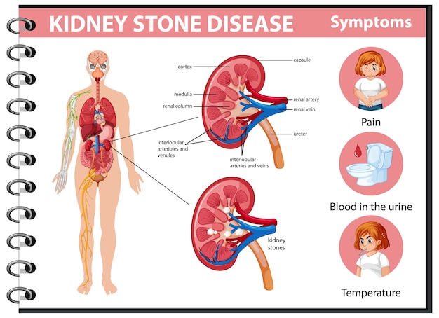 Kidney stones disease and symptoms infographic