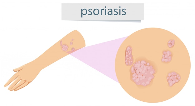 Magnified psoriasis on arm