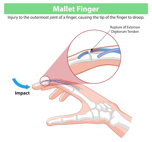 Free vector mallet finger injury illustration