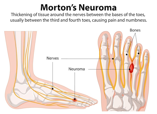 Free Vector mortons neuroma illustration