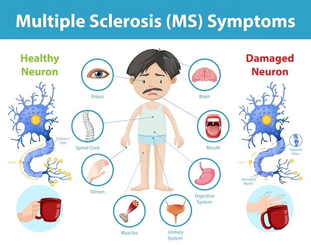 Multiple sclerosis (MS) symptoms information infographic