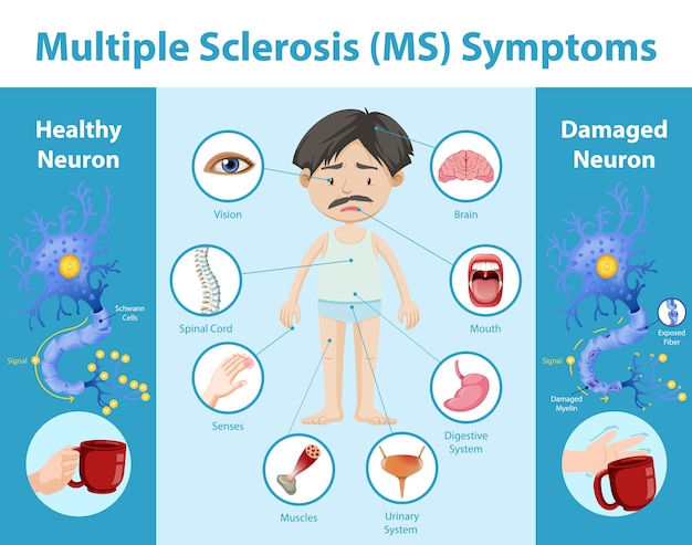 Multiple sclerosis (MS) symptoms information infographic